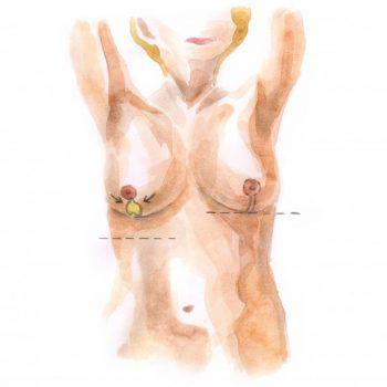 Breast reduction 1