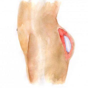 Buttocks enhancement with implants
