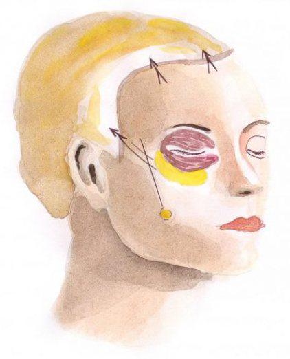 Endoscopic face lift