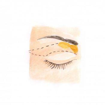 Eyelid plastic surgery
