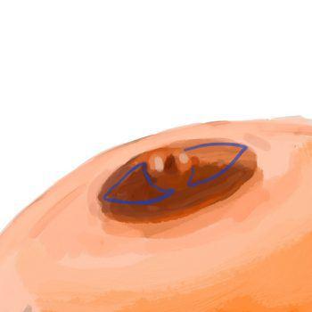 Inverted nipple correction 1