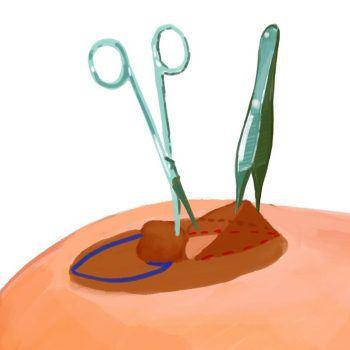 Inverted nipple correction 2