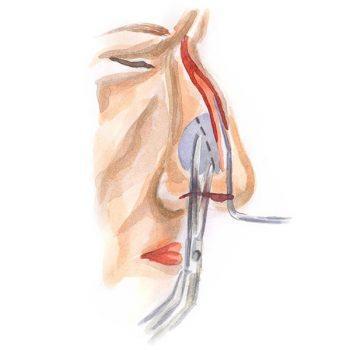 Nose shape correction 3