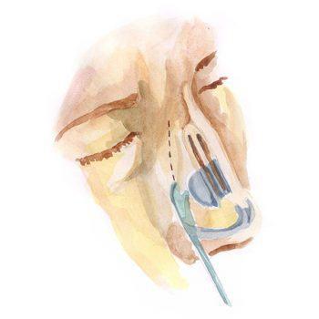 Nose shape correction 5