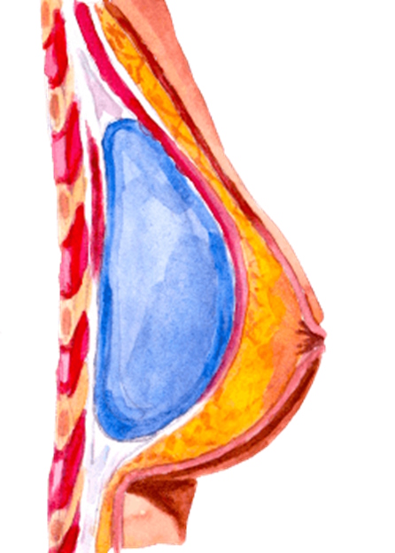 PARTIALLY UNDER THE MUSCLE