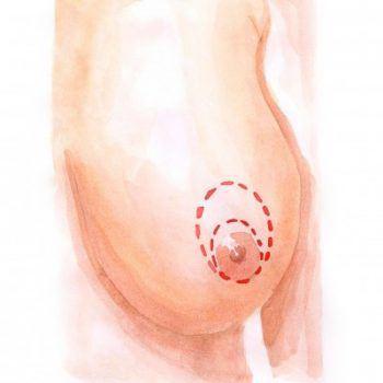 breast lifting 2