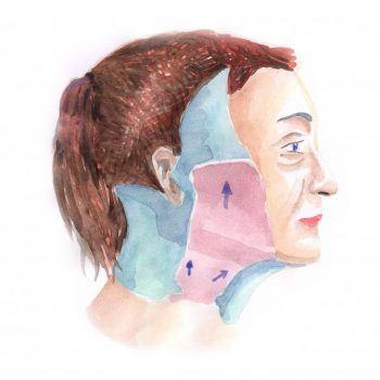 face lift 1