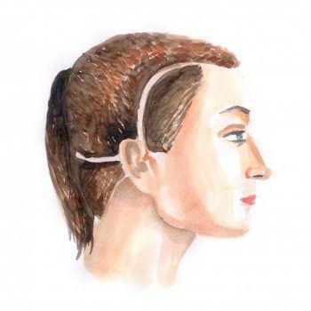 face lift 3