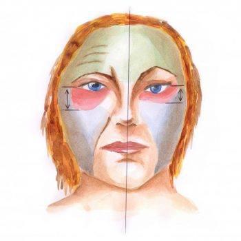 face lift 4