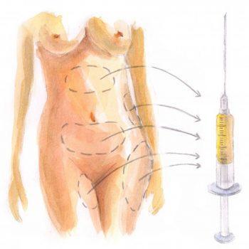 Buttocks enhancement with fat