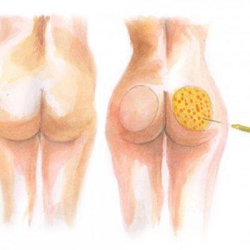Buttocks enhancement with fat