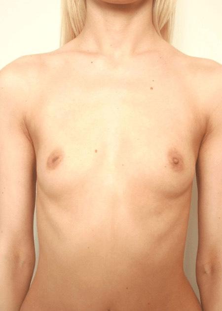 Breast augmentation with implants before