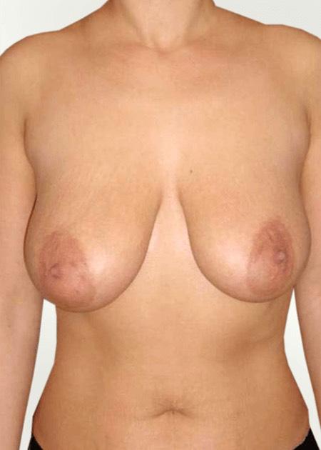 Breast lift before
