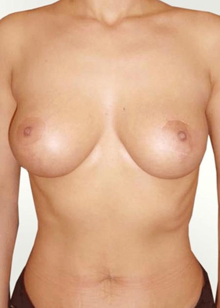 Breast lift after