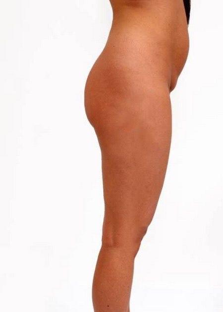 Buttocks enhancement with fat before