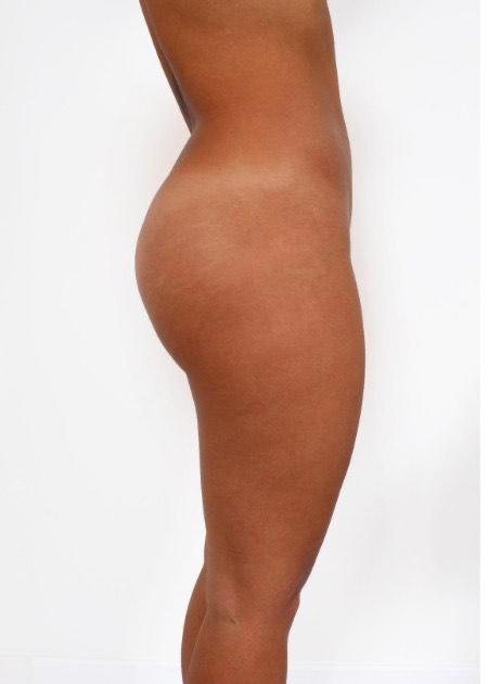 Buttocks enhancement with implants after