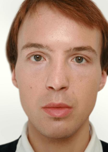 CHEEK IMPLANTS – CHEEK ENHANCEMENT before