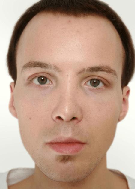 CHEEK IMPLANTS – CHEEK ENHANCEMENT after