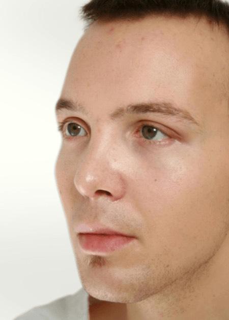 CHEEK IMPLANTS – CHEEK ENHANCEMENT after