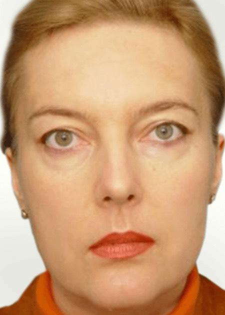 Endoscopic face lift before