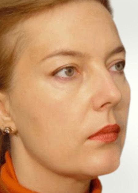 Endoscopic face lift before