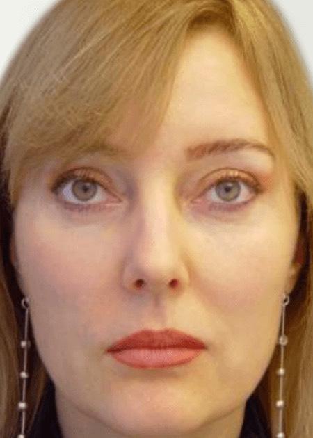 Endoscopic face lift after
