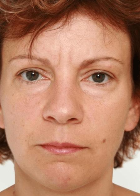 Eyelid plastic surgery before