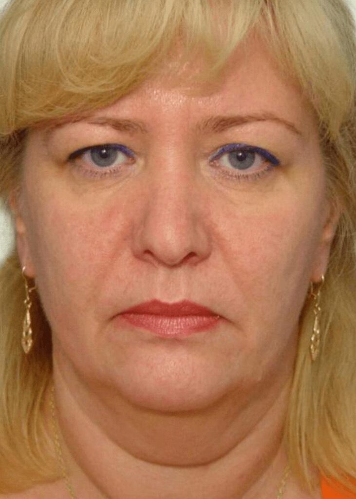 Face lift 2 before