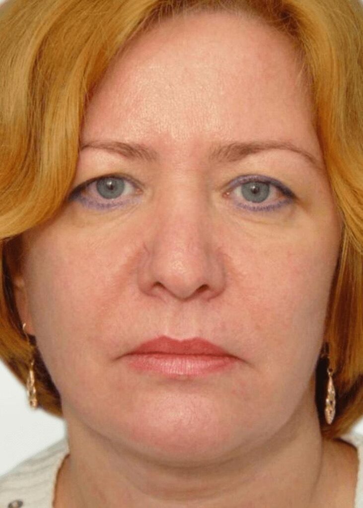 Face lift after