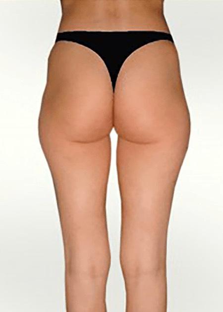Fatt suction before