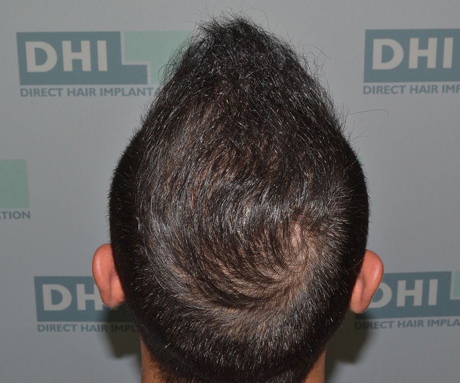 Hair transplantation
