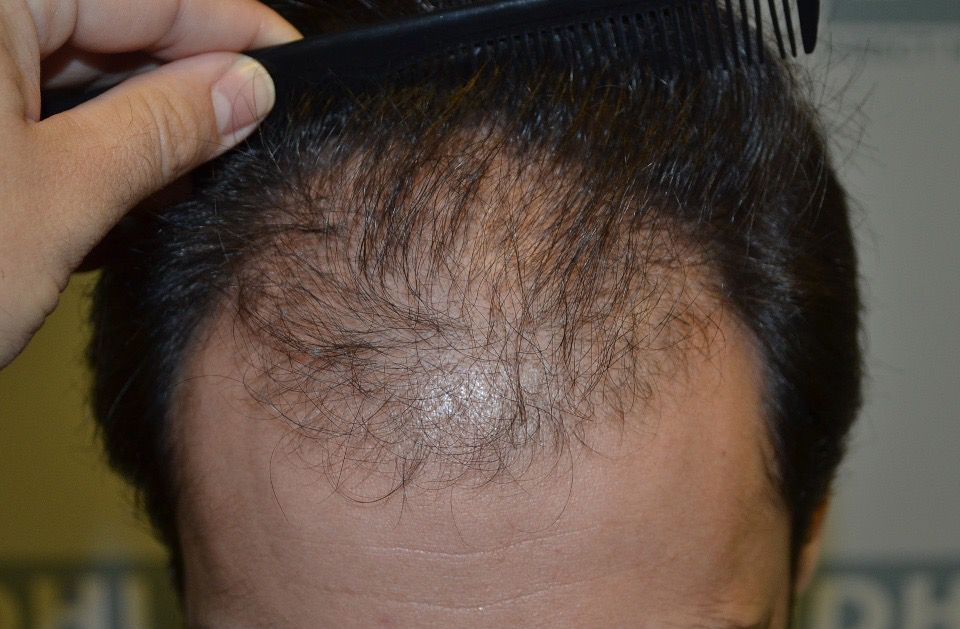 Hair transplantation