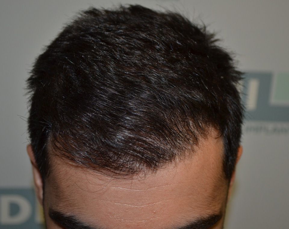 Hair transplantation