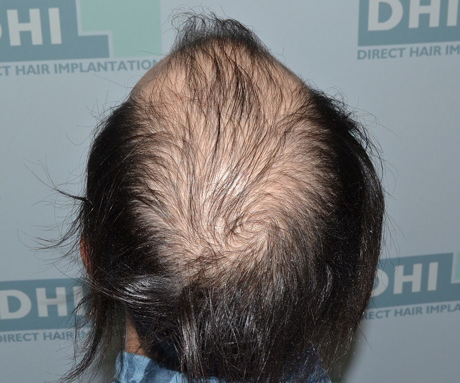 Hair transplantation