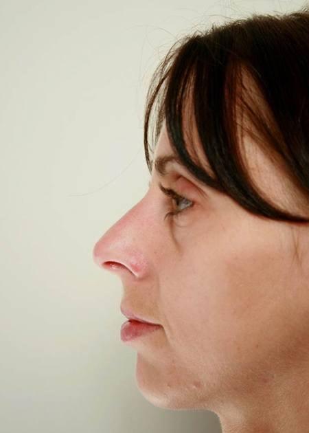 Nose shape correction 2before