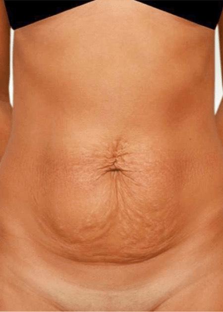 Tummy tuck before