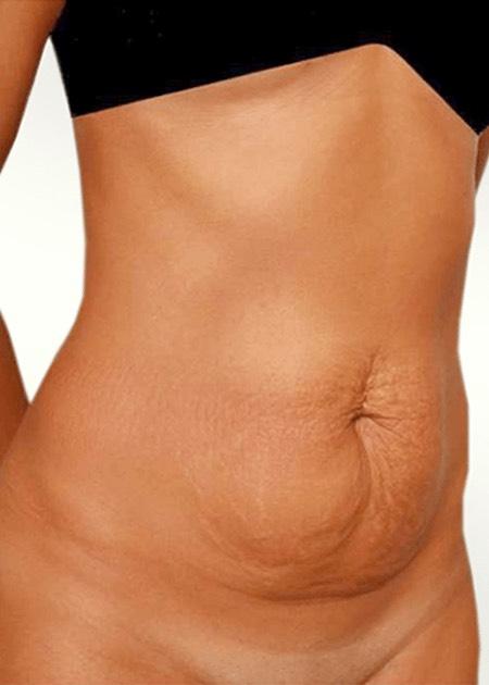 Tummy tuck before