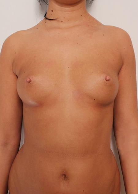Breast enhancement with fat before